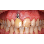 Klinik Şartlarında Periimplantitis ve Tedavisi