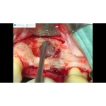 Lateral Sinüs Lifting